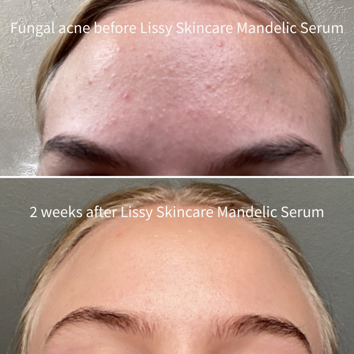 Mandelic Serum 5%