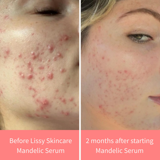 Mandelic Serum 5%