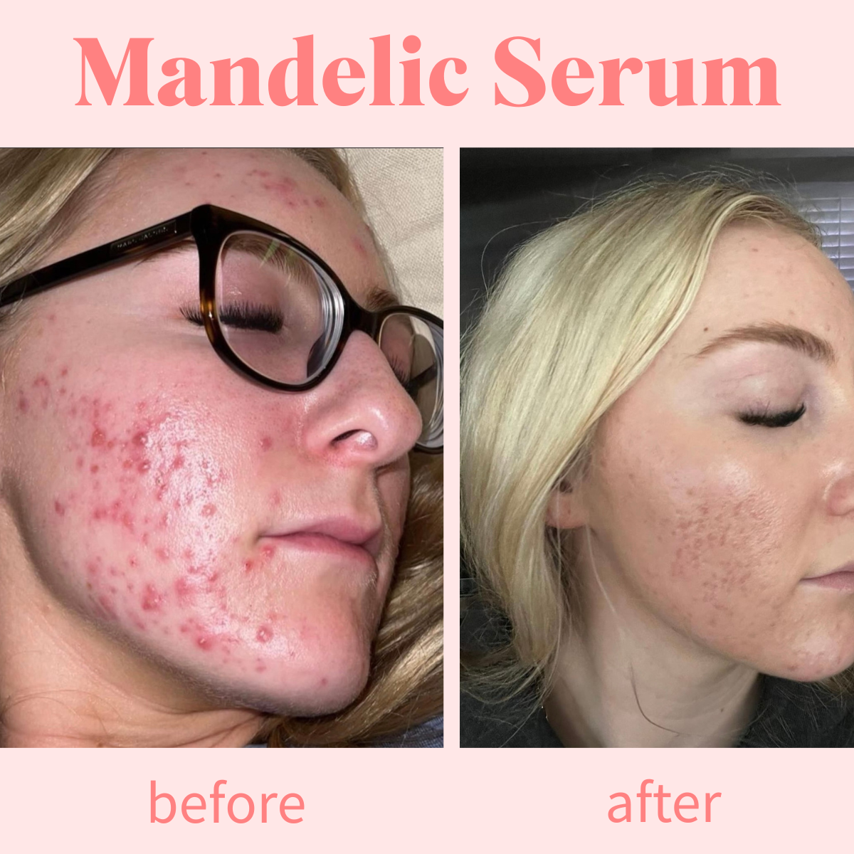 Mandelic Serum 5%